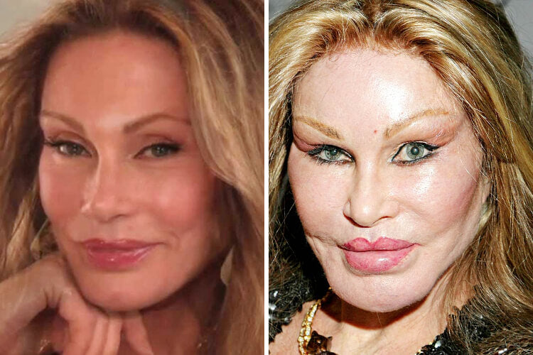 When Celebrity Plastic Surgeries Go Wrong—See The Bizarre Transformati ...