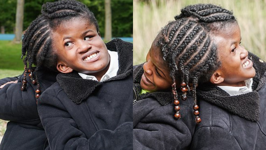 Conjoined Twins With A Life Expectancy of 10 Years, Thrives at 18!